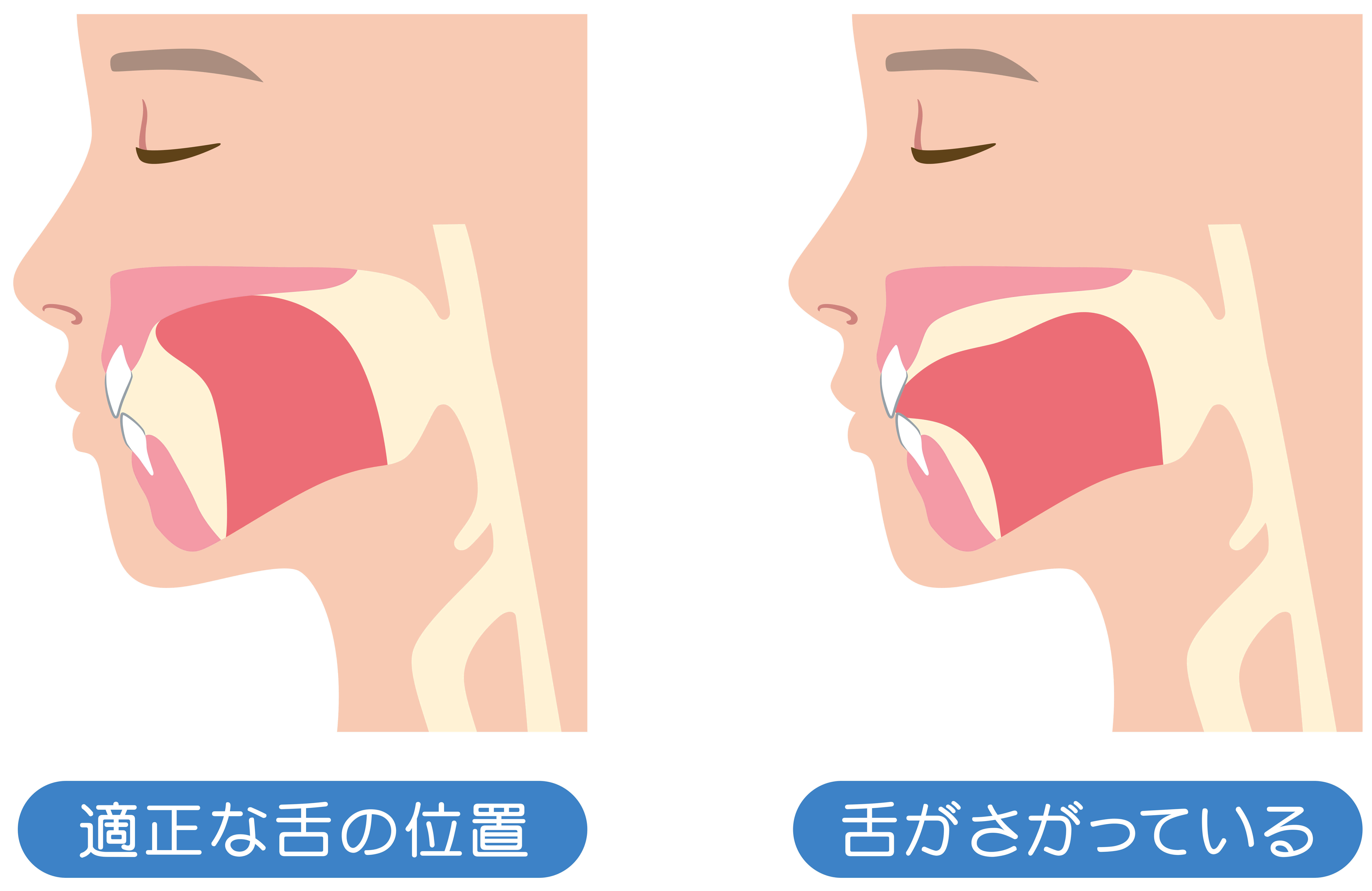高田馬場の矯正歯科・舌側矯正、さとう矯正歯科の口腔筋機能療法（MFT）