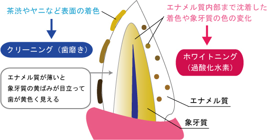 高田馬場の矯正歯科・舌側矯正、さとう矯正歯科のホワイトニング